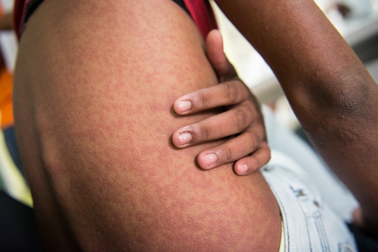 Rash caused by Chikungunya (Photo via Caribbean Journal)